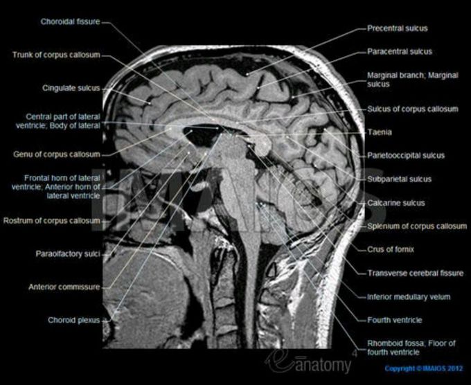 Brain MRI