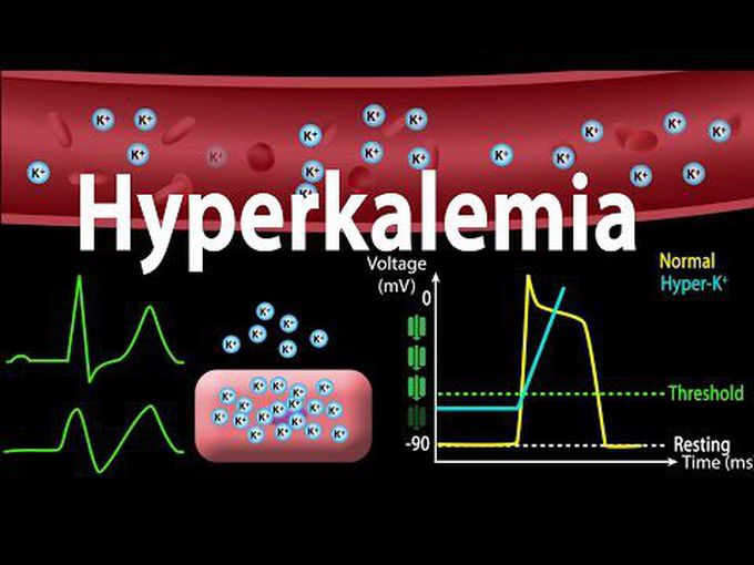 Hyperkalemia and its effect on the heart