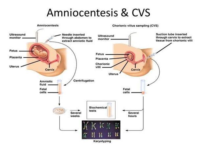 Amniocentesis and CVS