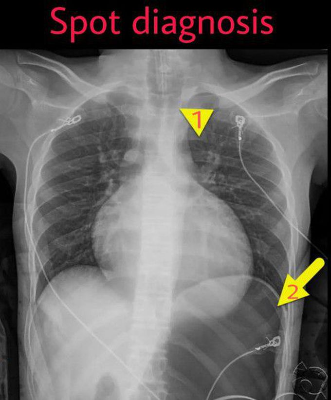 Esophageal Intubation