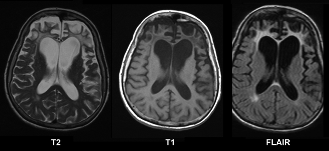 Pick’s Disease AKA Frontotemporal Dementia