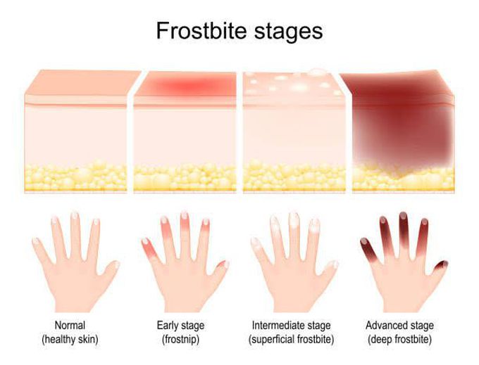 Frostbite Stages