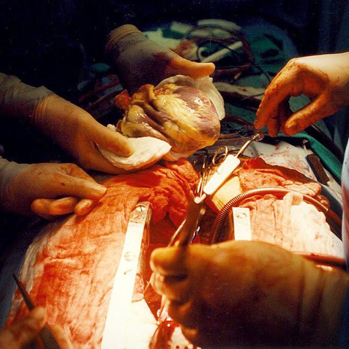 Heart transplant