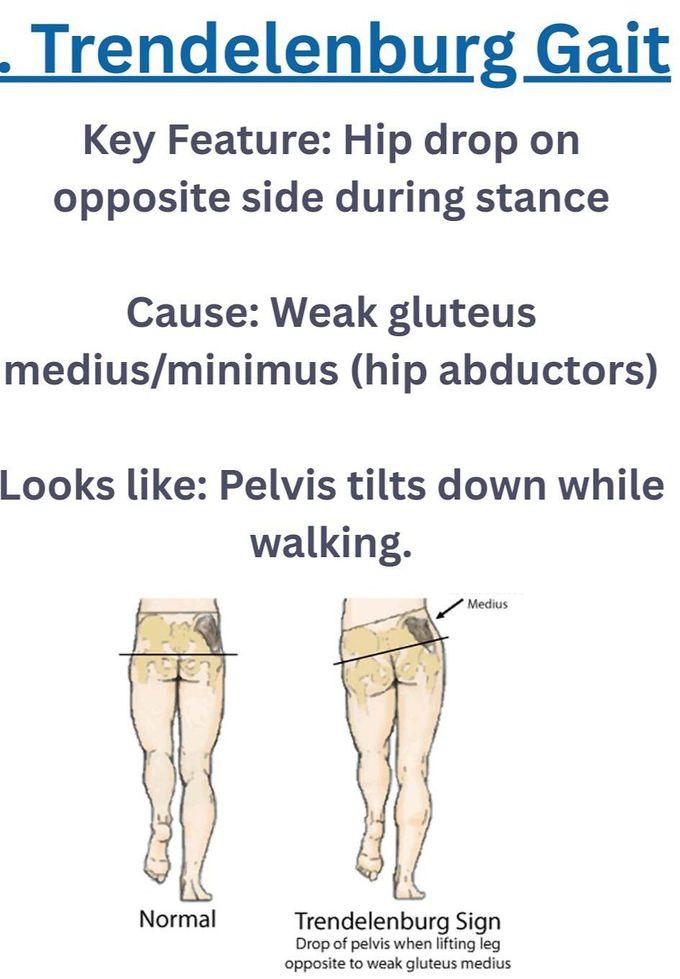 Trendelenburg Gait