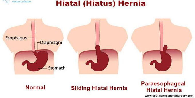 Types of Hiatal hernia