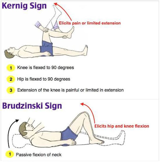 Kernig Signs and Brudzakinski's sign