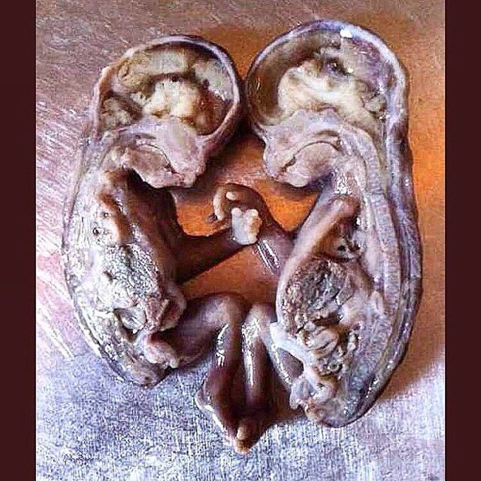 That's a sagittal cut of a fetus, about 14 weeks of gestation