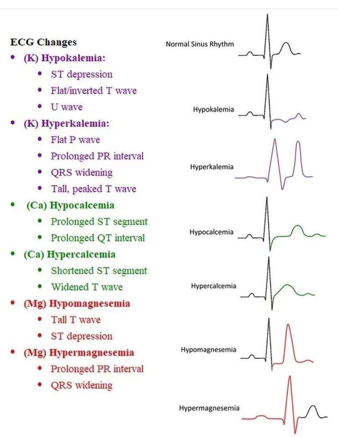 ECG Changes