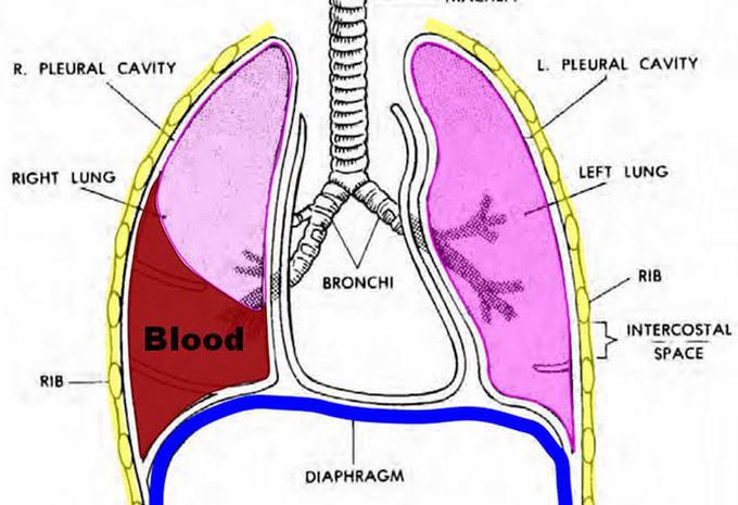 Hemothorax