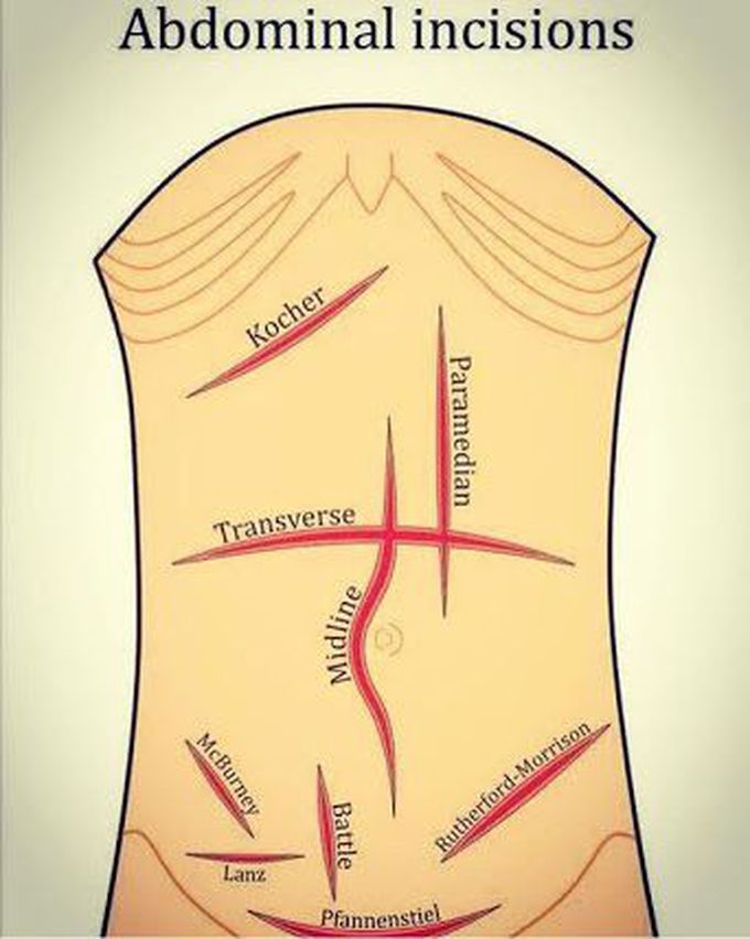 Incisions
