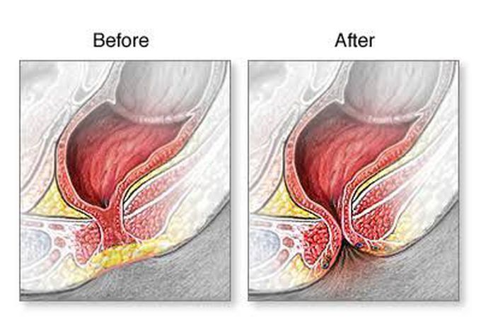 Imperforate anus