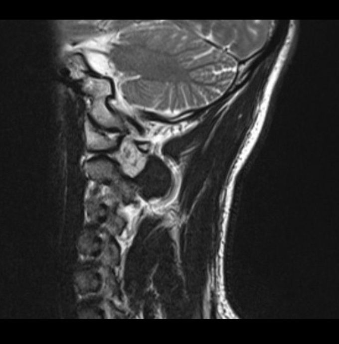 Unknown cervical mass