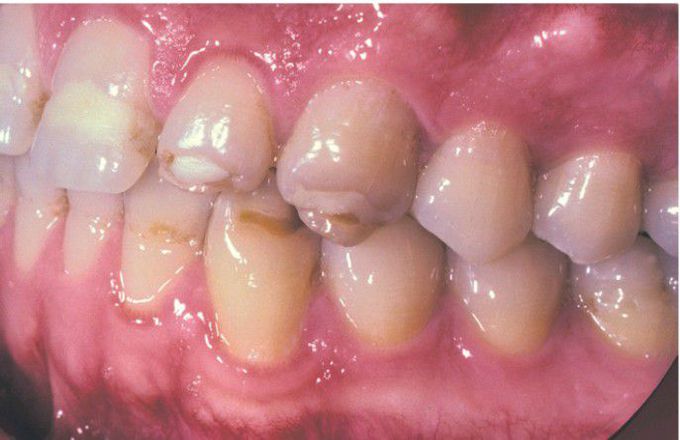 Environmental enamel hypoplasia