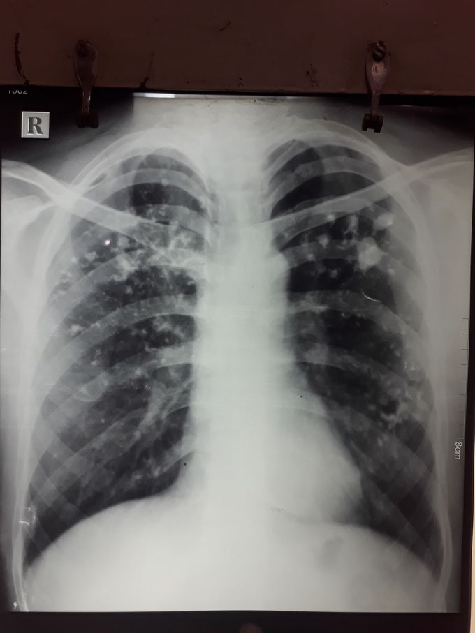 Past h/o ATT for 9 month. C/o haemoptysis since week and DOE ch smoker