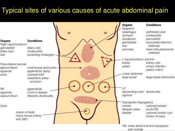 Regions of acute abdominal pain .. very important clinically lower abdomen diagram 