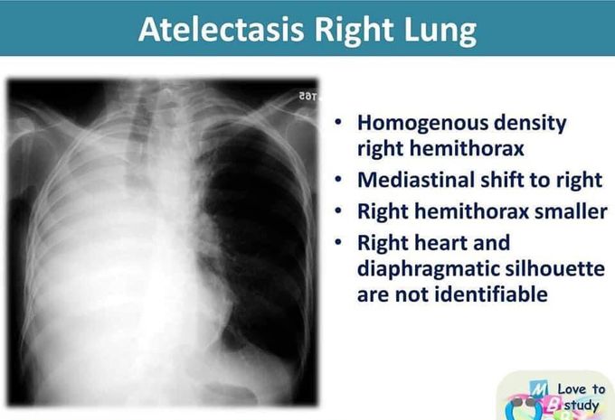 Atelectasis of right lung CXR