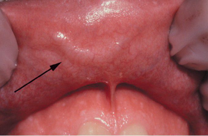 Caliber persistent artery