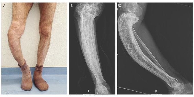 Saber Tibia in Paget's Disease of Bone