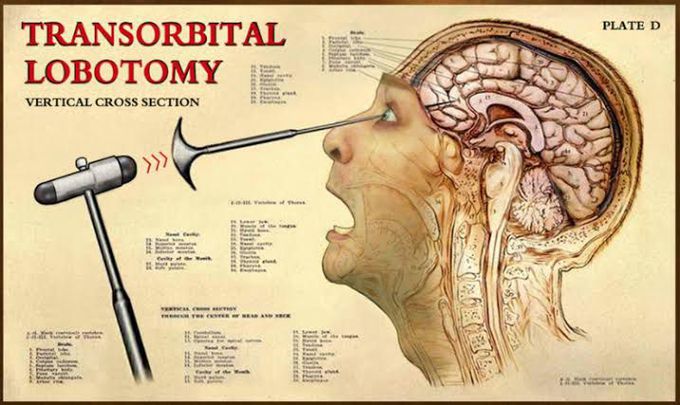 Lobotomy or Prefrontal Leukotomy