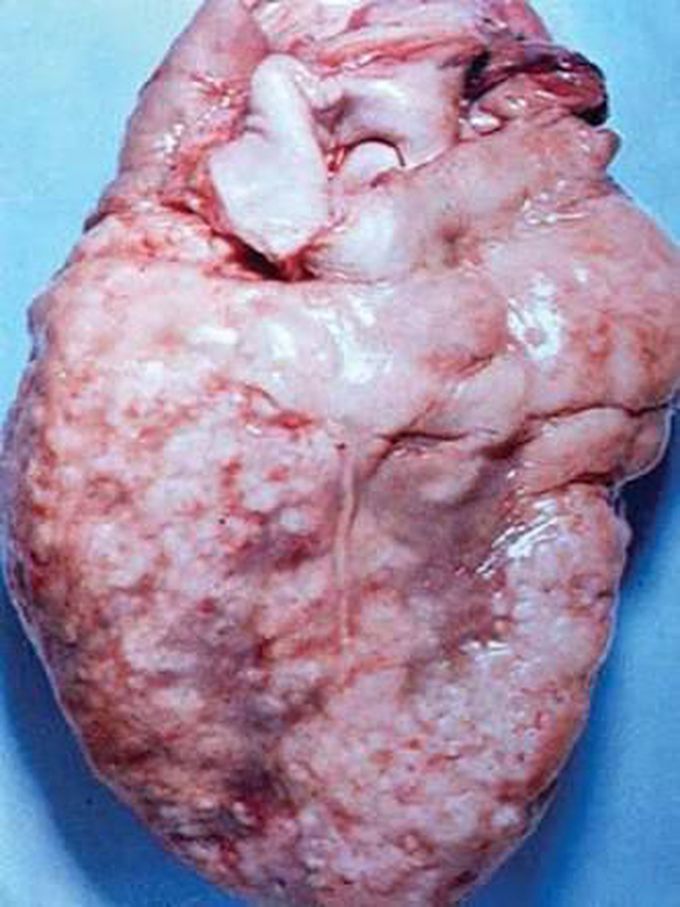 Heart disease