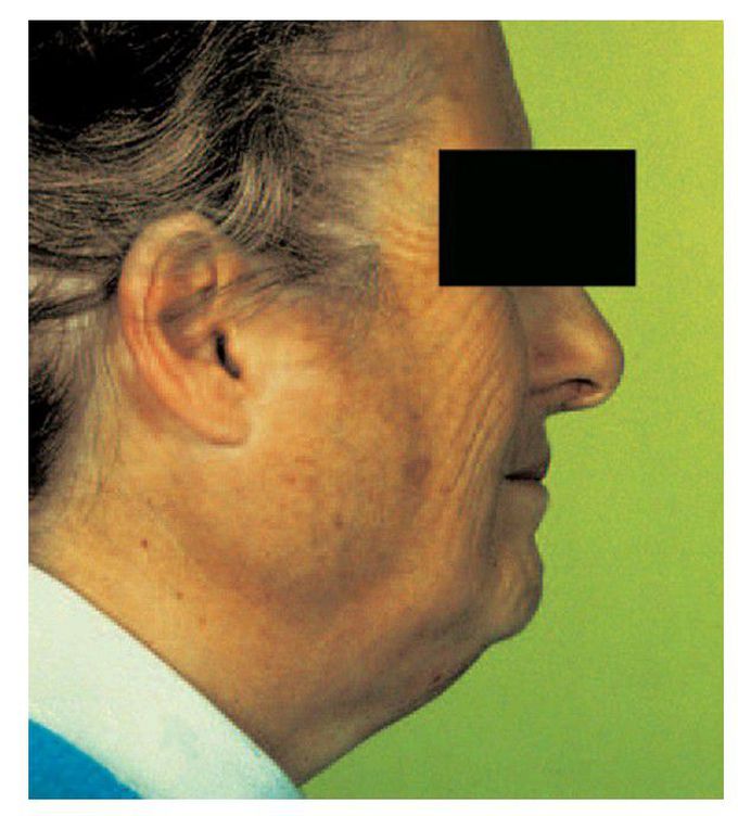 Sjogren syndrome