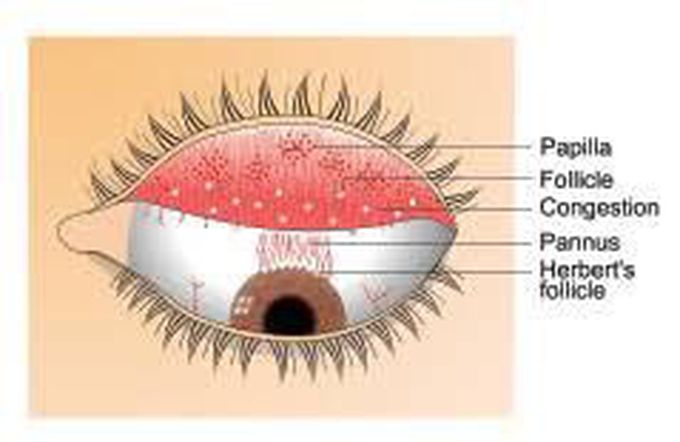 Conjunctivitis