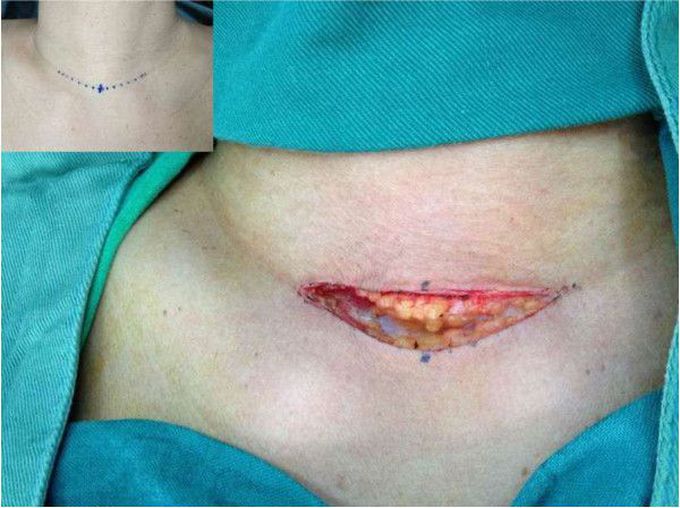 What's the name of this incision?