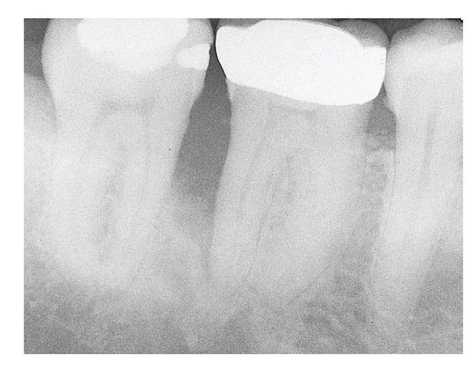 Treatment planning in endodontics