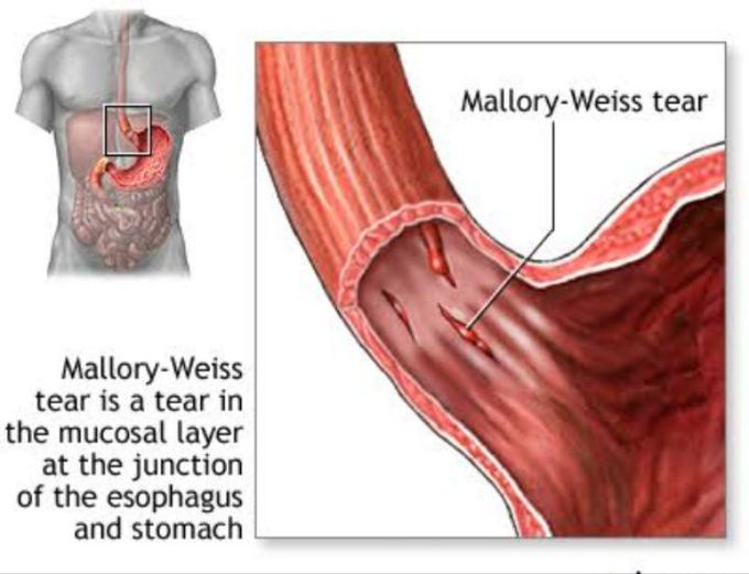 Mallory weiss syndrome