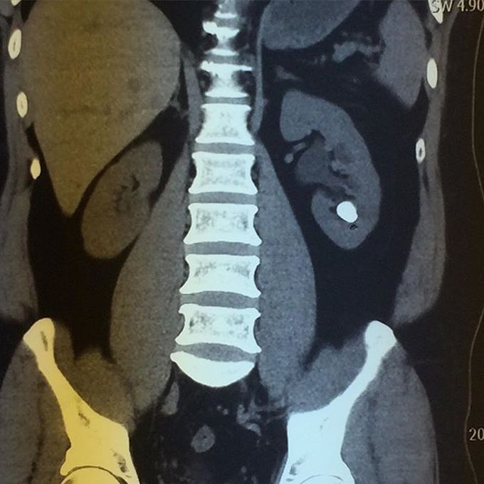 Kidney calculus