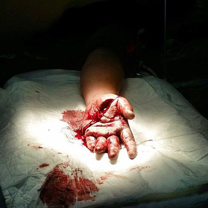 Left hand laceration injury to a 27-year-old male who got into a fight!