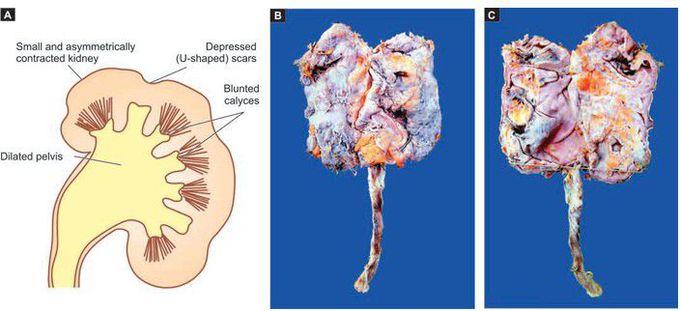 Small contracted kidney in chronic pyelonephritis with calyectasis