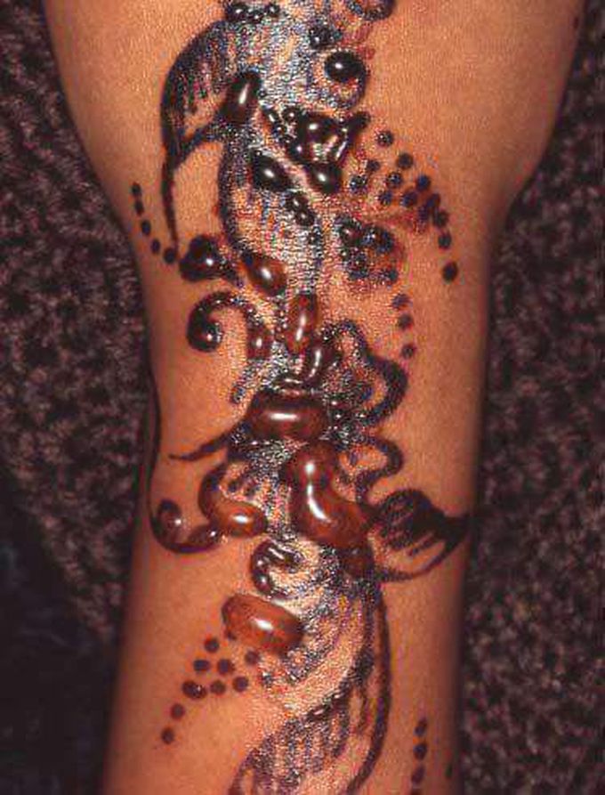 Allergic contact  dermatits