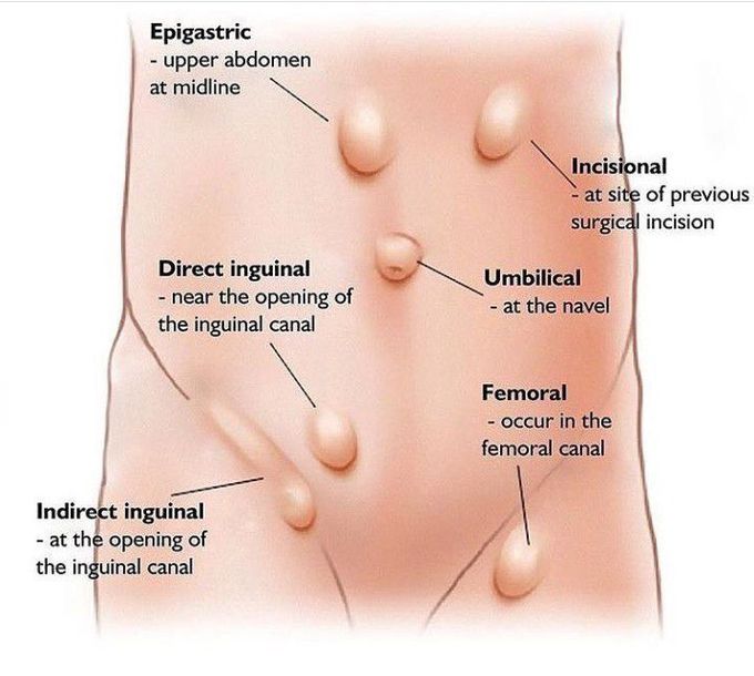 The most common types of hernia is inguinal hernia! About 96% of all hernias is inguinal! 