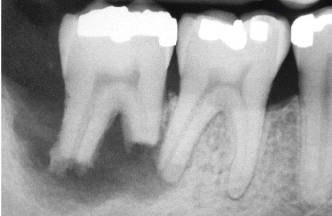 External resorption