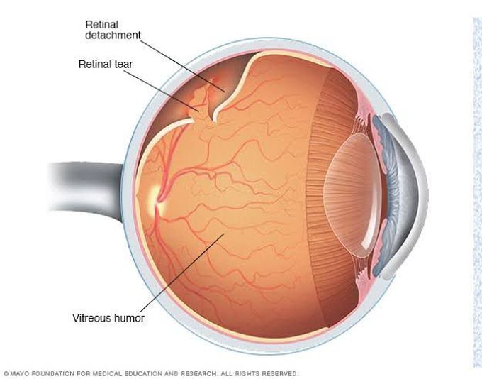 Retinal detachment