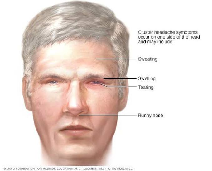 Cluster Headache In German Language