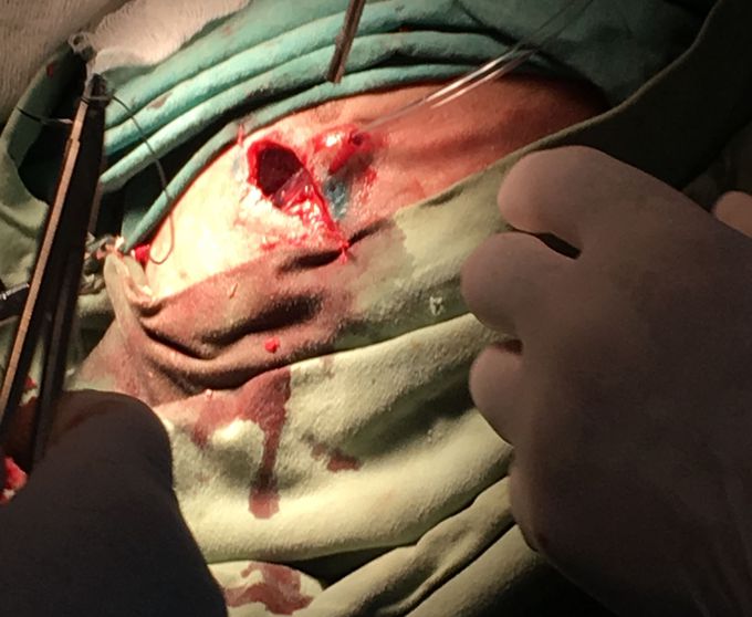 Removing subdural hematoma