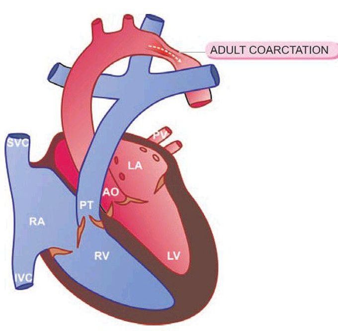 Postductal  coarctation of the aorta