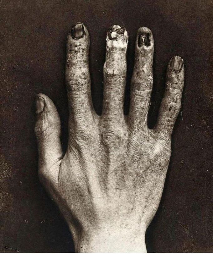 Radiation damage back in 1900s