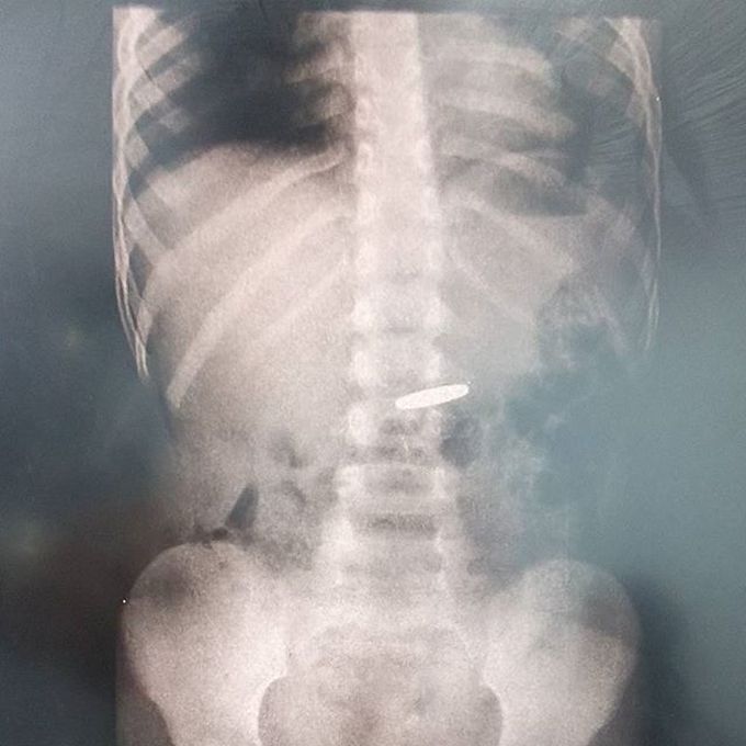 Foreign Body X-Ray