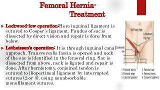 Treatment of femoral hernia