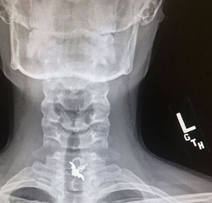 There was an old woman who swallowed a... bat earring?
