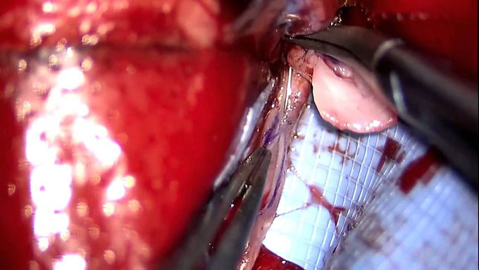 Giant Left Middle Cerebral Artery Aneurysm