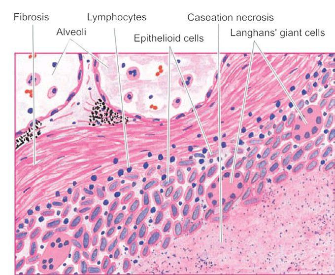 Secondary tuberculosis