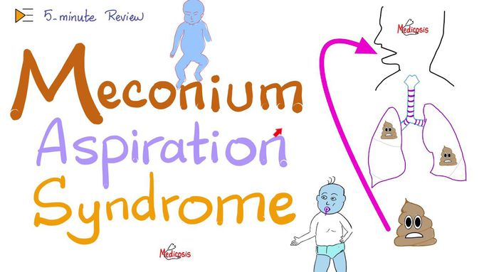 Meconium Aspiration Syndrome