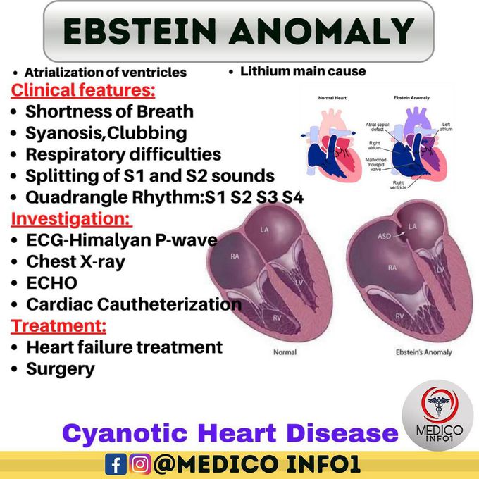 Ebstein Anomaly