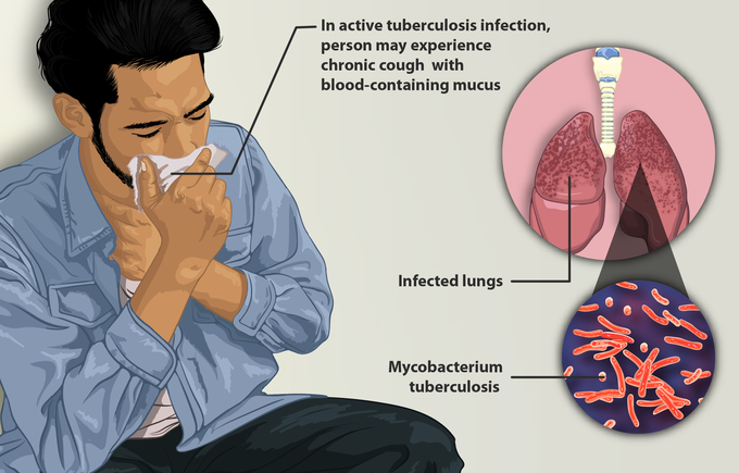 What are the signs and symptoms of tuberculosis?