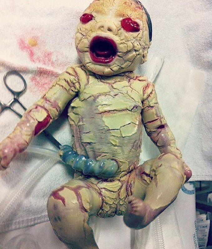 Here is a rare shot of a condition called ichthyosis. 