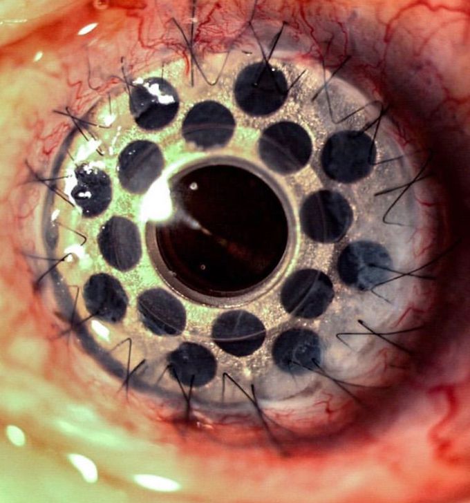 Case study on the ophthalmology What is the name of this condition ?